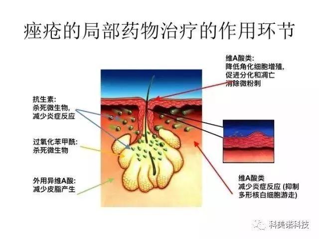 痤疮的常见综合治疗方法，非常详细值得一看！