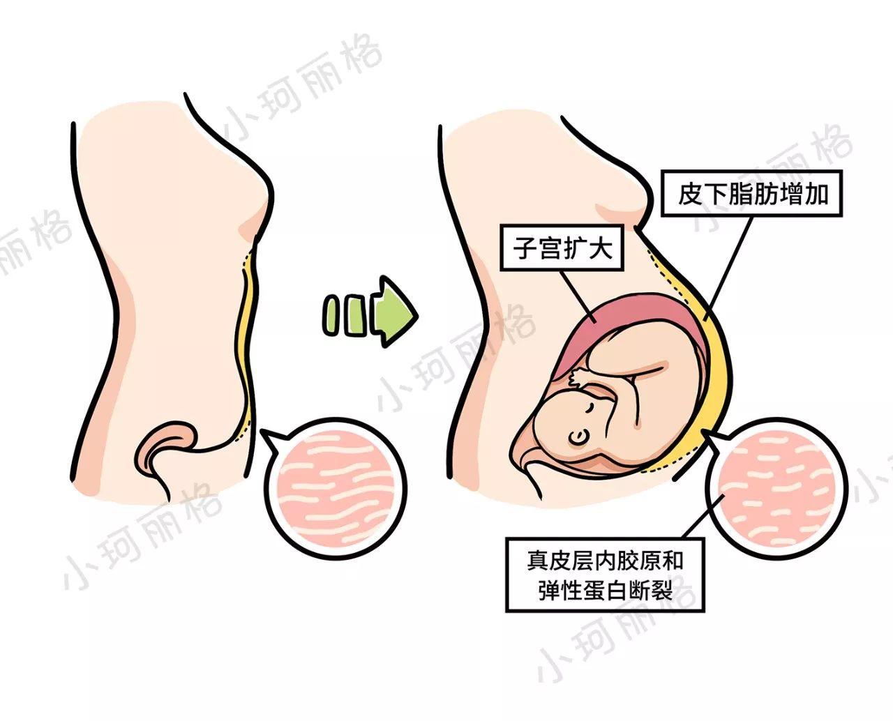 看完这篇妊娠纹科普，80%的女人脱掉衣服开始照镜子