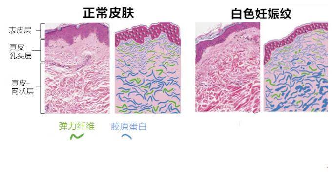 看完这篇妊娠纹科普，80%的女人脱掉衣服开始照镜子