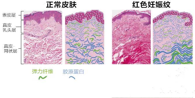 看完这篇妊娠纹科普，80%的女人脱掉衣服开始照镜子