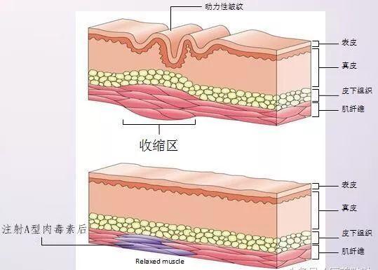 医美史|肉毒素200年：从香肠里的毒物到几百亿的生意（下）