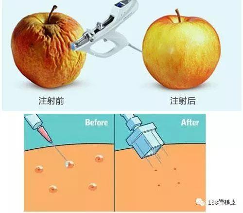 销售 | 水光针引导消费话术