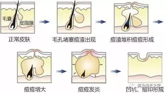 今日问答 | 为什么长痘后会留坑？