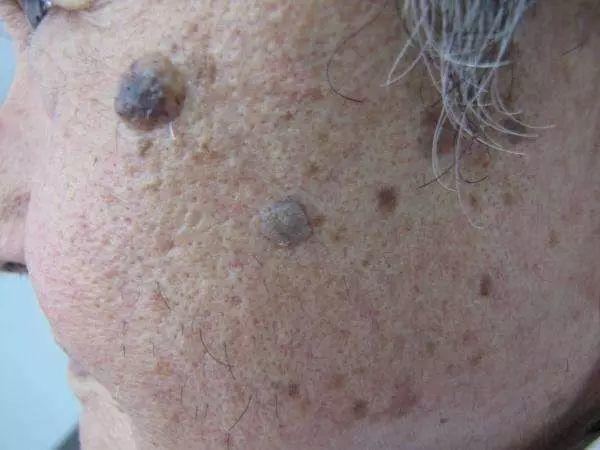 皮肤赘生物扁平疣、汗管瘤、粟丘疹、刺瘊......的专业知识