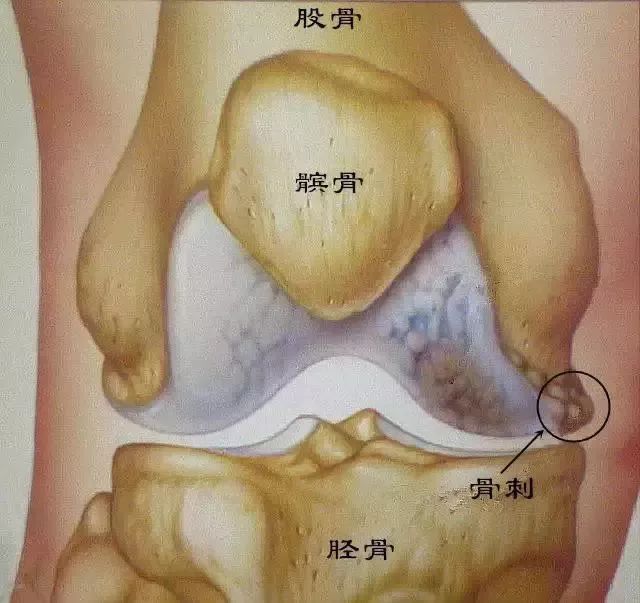 问答| 为什么会形成"骨刺"?长骨刺了怎么办?